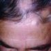 Patient Basics: Hair Loss