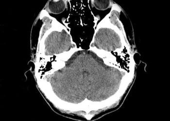 Abusive head trauma results in fewer productive life-years