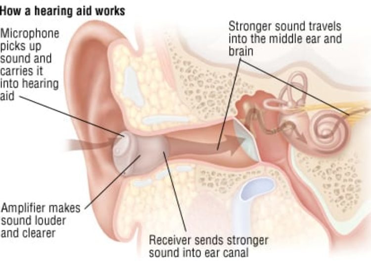 Patient Basics: Hearing Loss in Adults