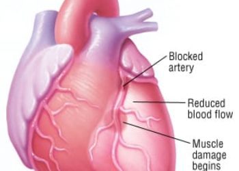 Patient Basics: Heart Attack (Myocardial Infarction)