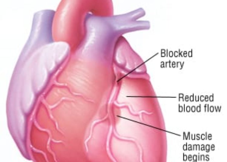 Patient Basics: Heart Attack (Myocardial Infarction)