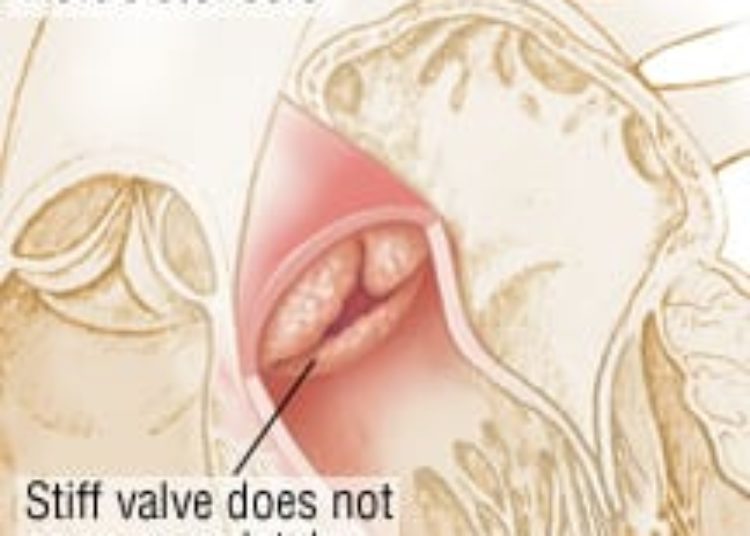 Patient Basics: Heart Murmur