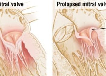 Patient Basics: Heart Murmur