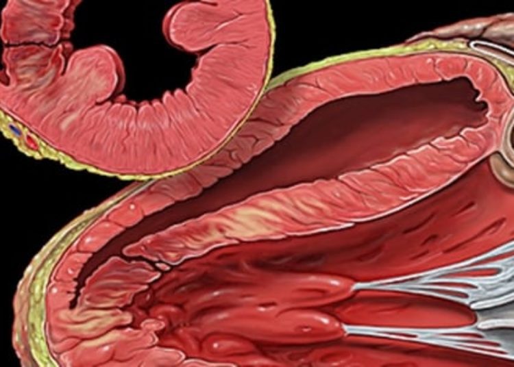 Shorter time to angioplasty may improve heart attack outcomes