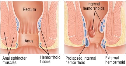 Treatment for external and internal Bleeding hemorrhoids