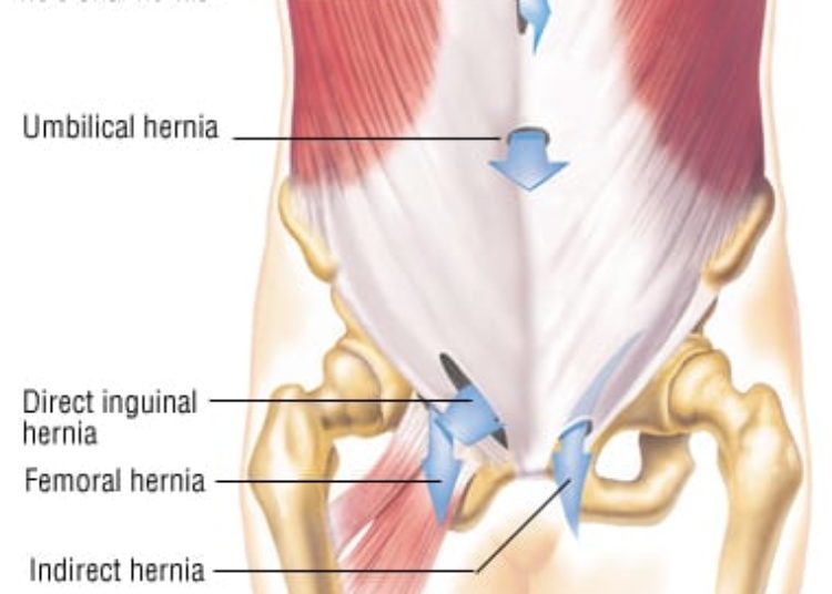 Patient Basics: Hernia Repair