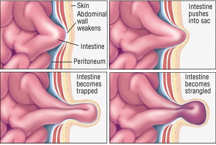 abdominal hernia in adults