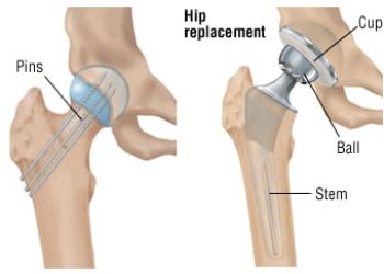 Patient Basics: Hip Fracture