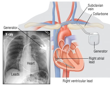 Cardioverter deals