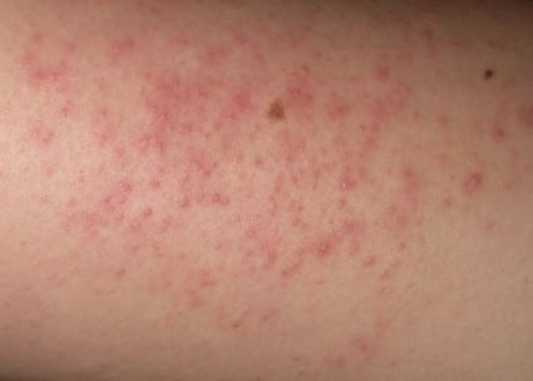 New laser therapy may improve the skin texture of keratosis pilaris