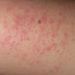 New laser therapy may improve the skin texture of keratosis pilaris