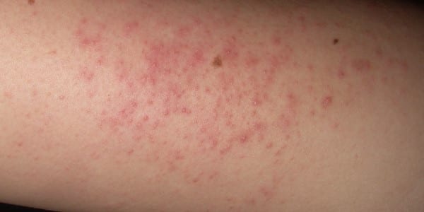 New laser therapy may improve the skin texture of keratosis pilaris | 2 Minute Medicine