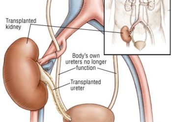Patient Basics: Kidney Transplant
