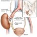Patient Basics: Kidney Transplant