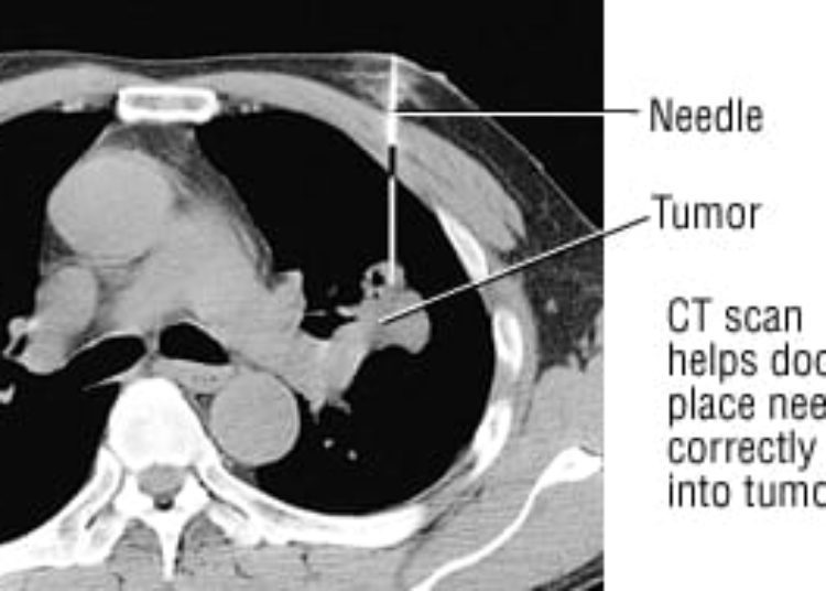 Patient Basics: Large Cell Cancer of the Lung