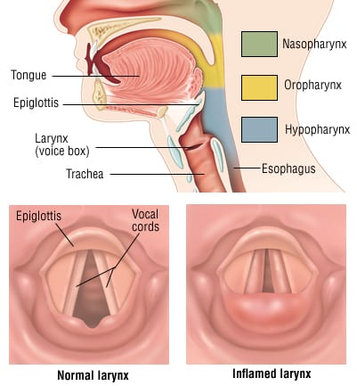 laryngitis diagram