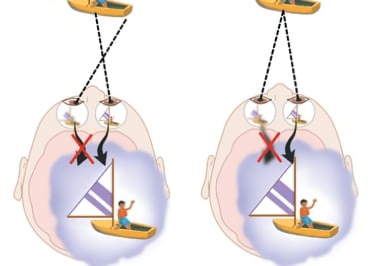 Patient Basics: Lazy Eye (Amblyopia)