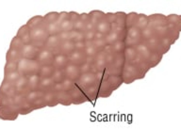 Patient Basics: Liver Cancer