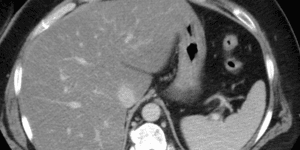 Berberine is safe and effective in lowering lipoprotein cholesterol levels in metabolic dysfunction-associated steatotic liver disease