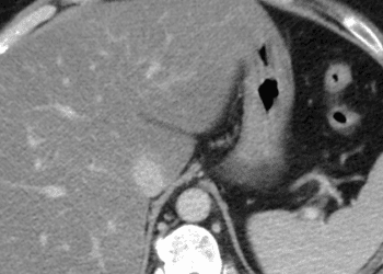 Fatty liver disease may independently predict high-risk coronary disease