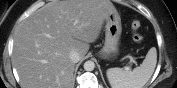 fatty liver