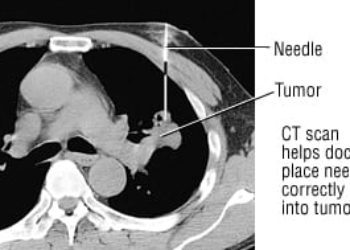 Patient Basics: Lung Cancer Overview