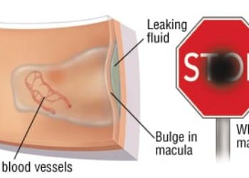Patient Basics: Macular Degeneration