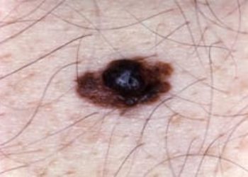 Patient Basics: Melanoma