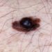 Patient Basics: Melanoma