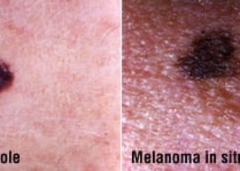 Patient Basics: Melanoma