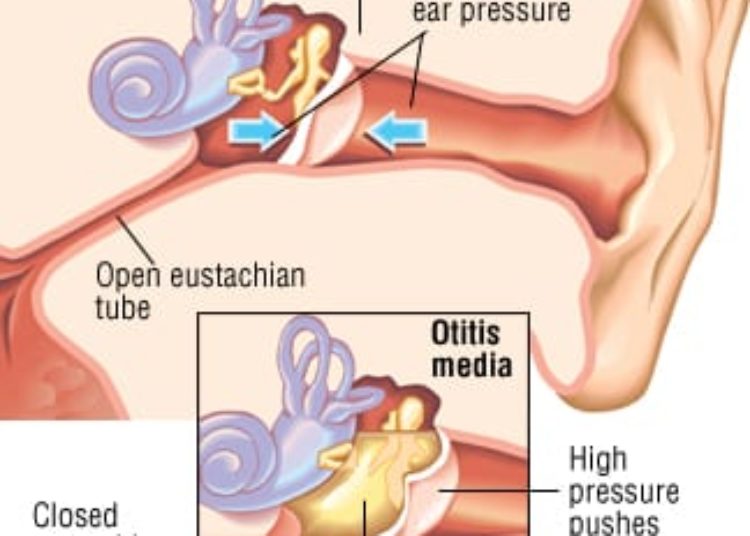 Patient Basics: Middle-Ear Infection (Otitis Media)