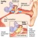 Patient Basics: Middle-Ear Infection (Otitis Media)