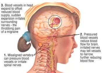Patient Basics: Migraine