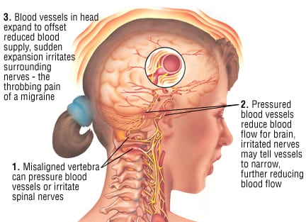 Patient Basics Migraine 2 Minute Medicine