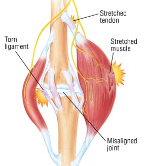 Torn muscle discount in arm