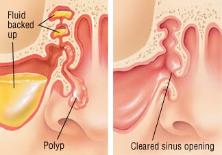 Nasal Polyps1