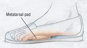 Neuroma 1