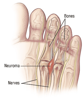 Neuroma