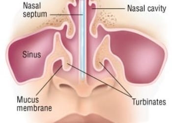 Patient Basics: Nosebleed (Epistaxis)
