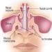 Patient Basics: Nosebleed (Epistaxis)