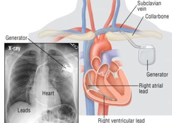 Patient Basics: Pacemaker