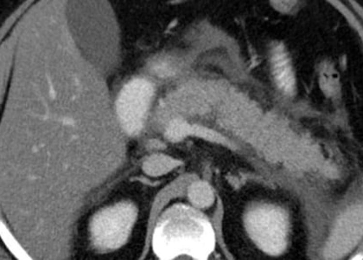 Early tube feeding unable to reduce infections in pancreatitis [PYTHON trial]