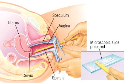 pap smear test
