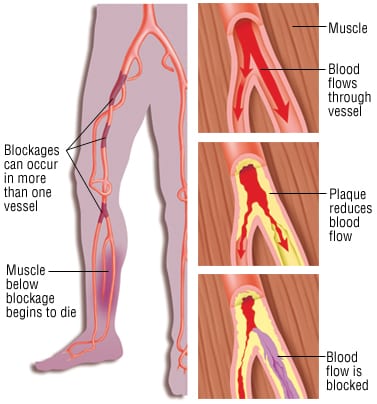 Can we reduce vascular plaque buildup? - Harvard Health