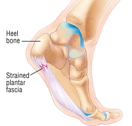 Plantar Fasciitis