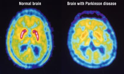 Patient Basics: Positron Tomography Scan) | 2 Medicine