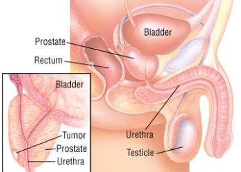 Patient Basics: Prostate-Specific Antigen Blood Test (PSA Test)