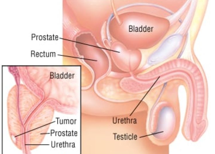 Patient Basics: Prostate-Specific Antigen Blood Test (PSA Test)