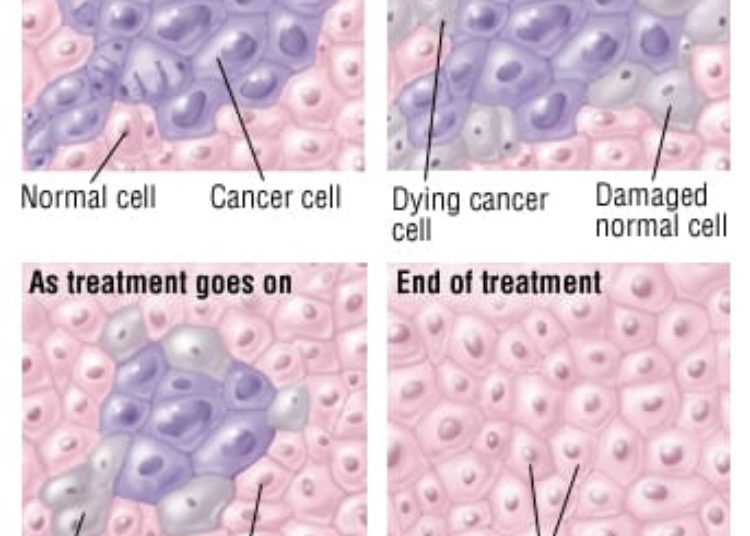 Patient Basics: Radiation Therapy