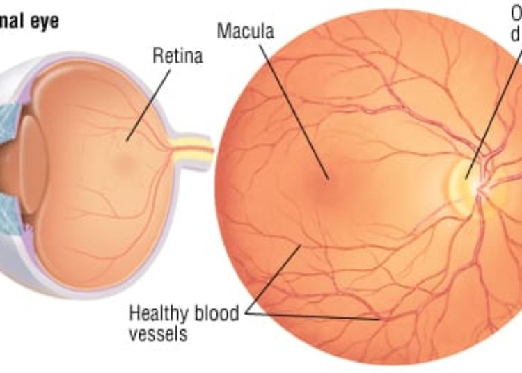 Patient Basics: Retinopathy